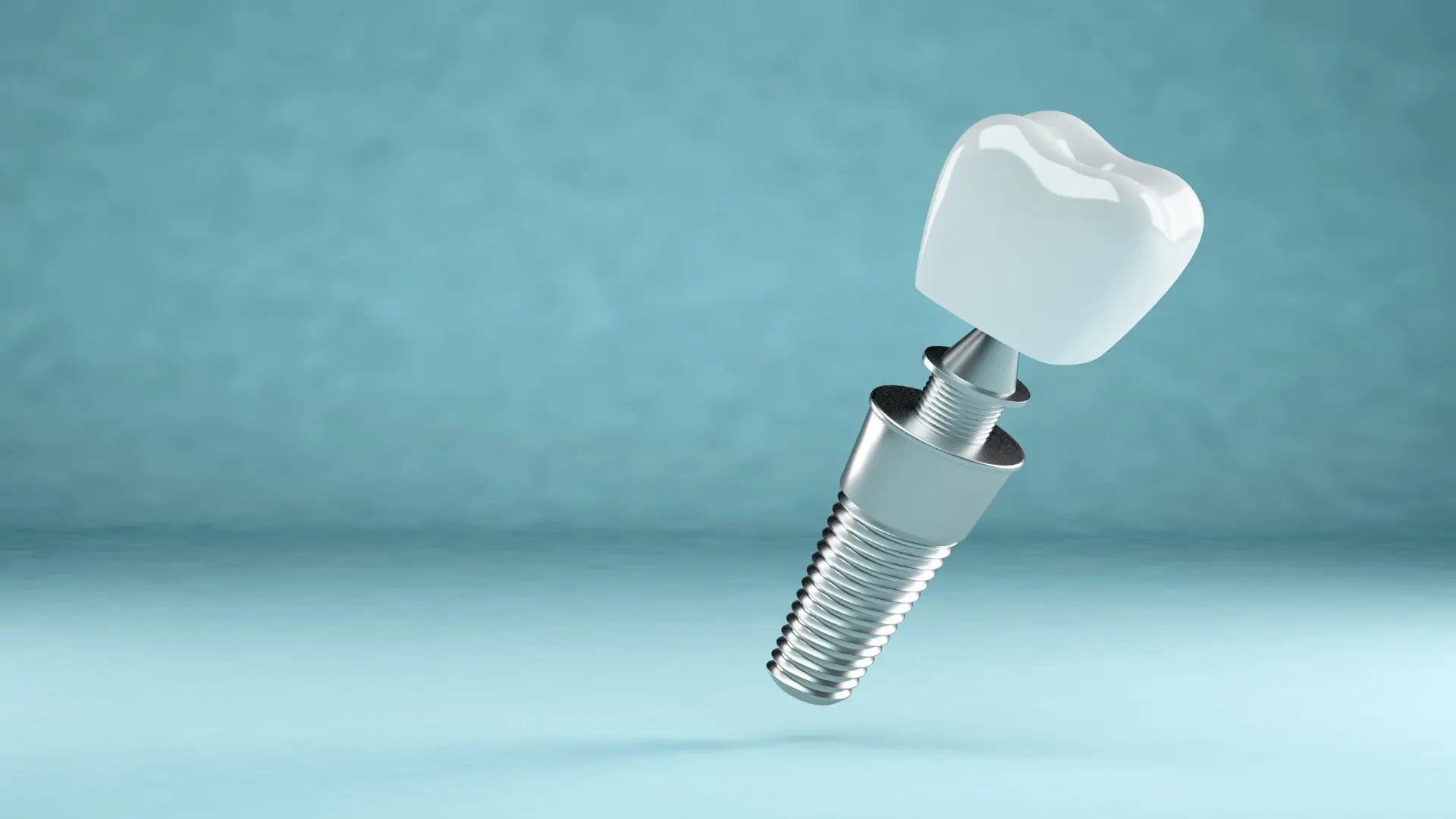 Implantes de carga inmediata en Chamberí — dientes en el mismo día | EDA Clínica Dental