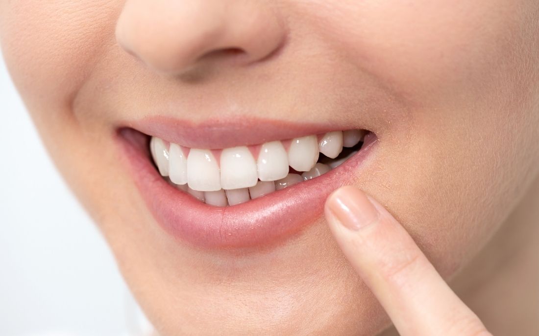 Blanqueamiento dental en domicilio