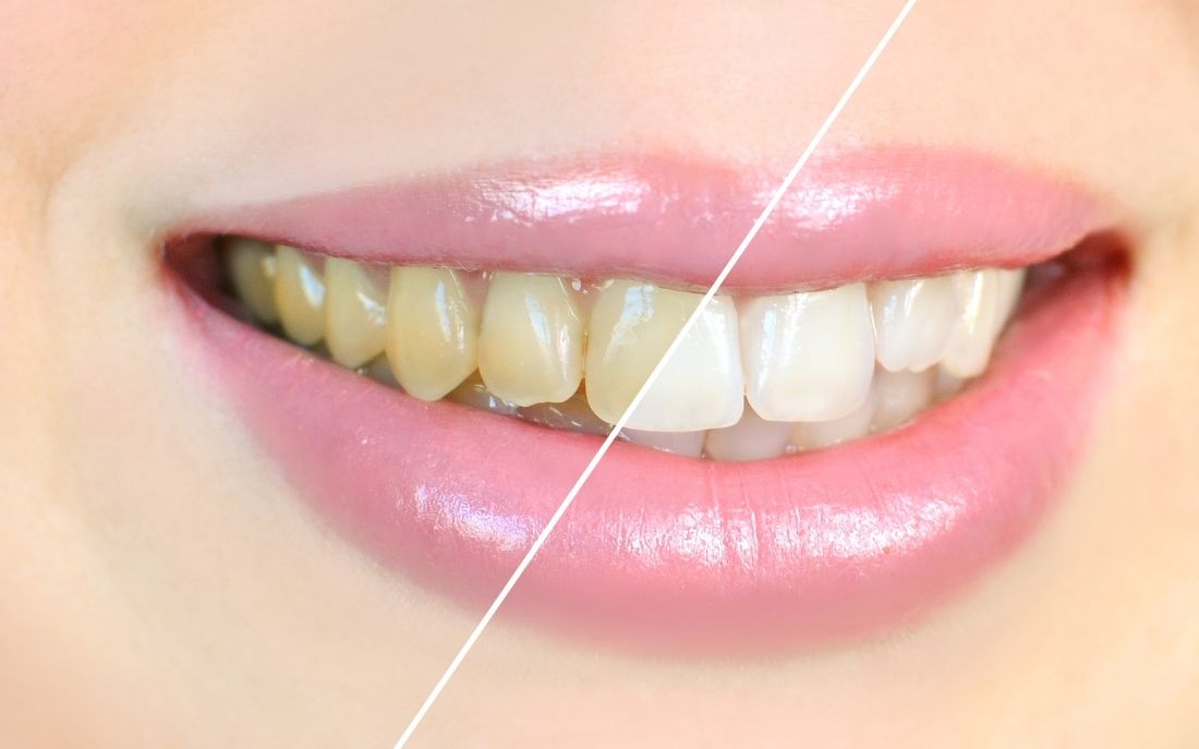 Blanqueamiento por fotoactivación