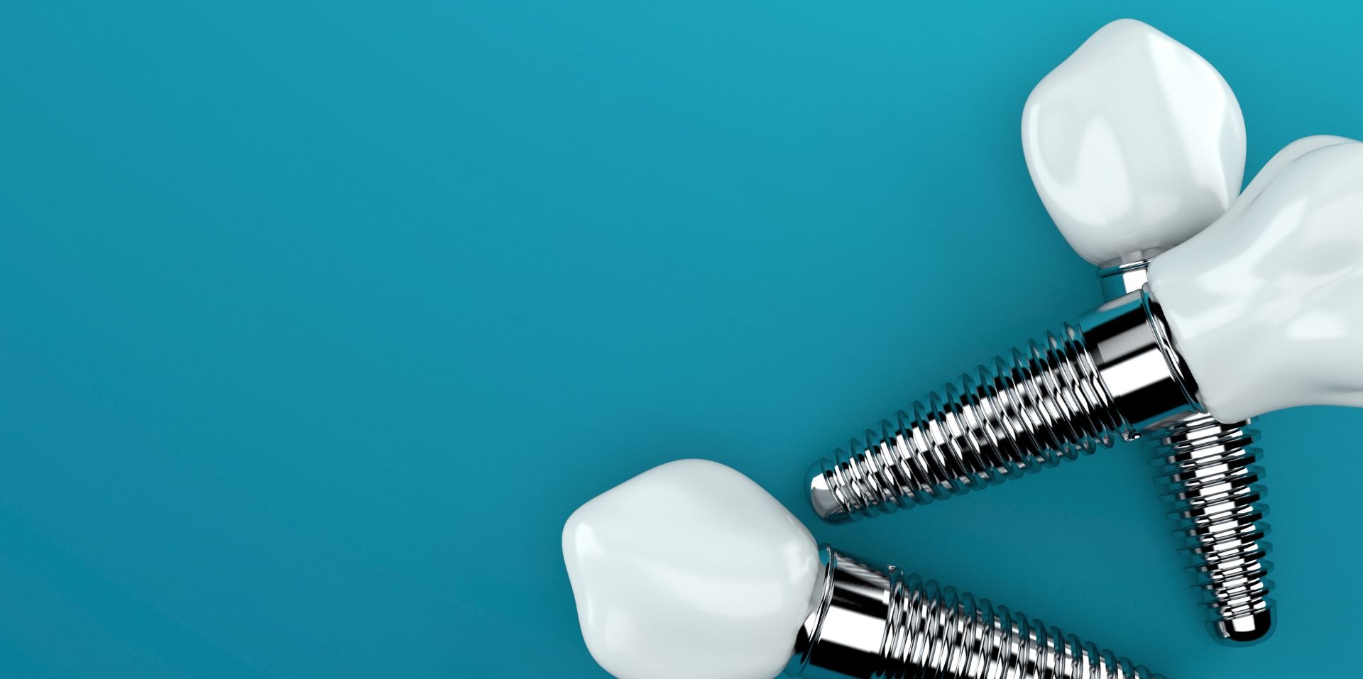 Implantes dentales — EDA Clínica Dental