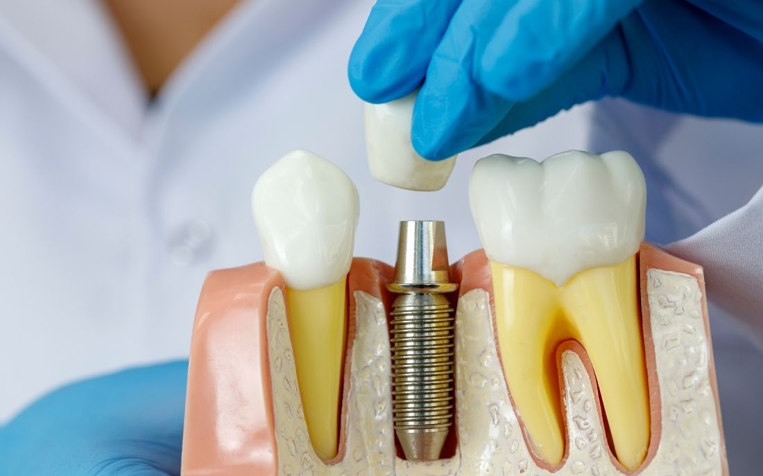 Dientes fijos en 24h