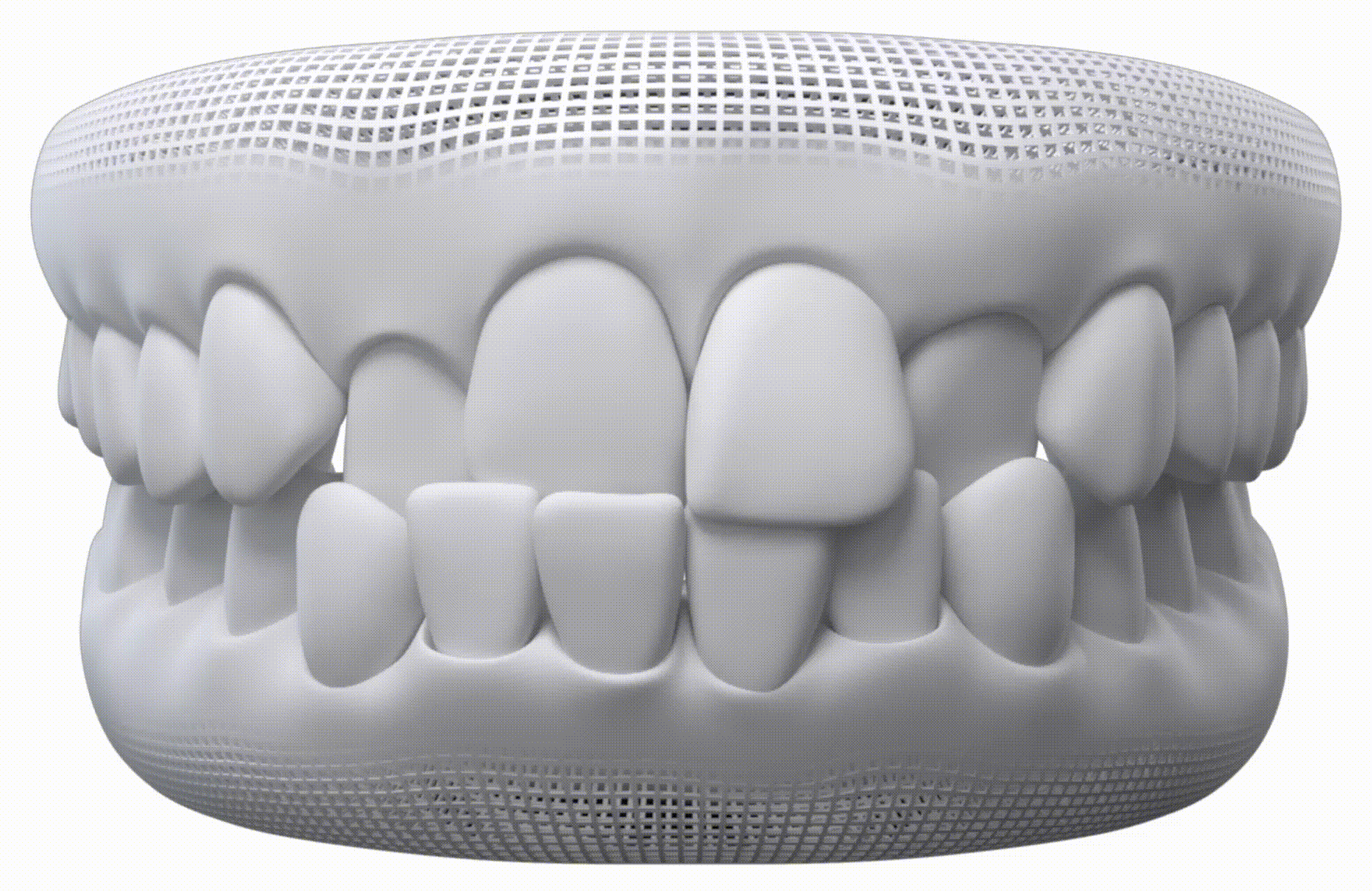 Mordida Cruzada — Invisalign en Chamberí