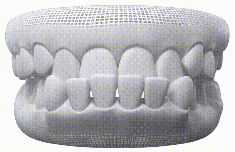 Mordida Inferior — Invisalign en Chamberí