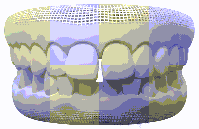 Dientes Huecos — Invisalign en Chamberí
