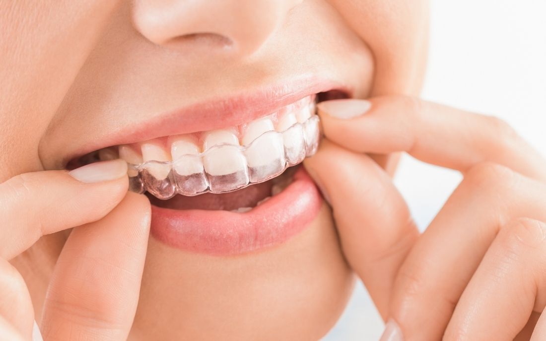 Invisalign Provider en Chamberí