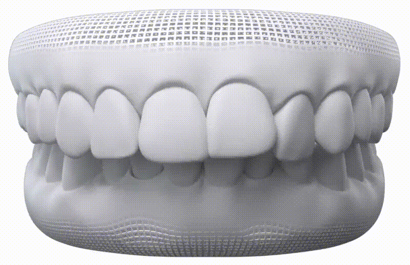 Sobremordida — Invisalign en Chamberí