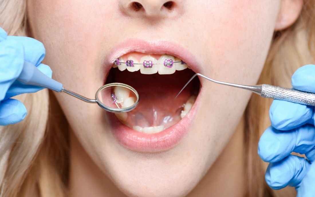 Ortodoncia con brackets en Chamberí — EDA Clínica Dental